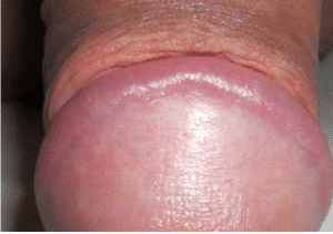 Swollen Penis Glans 62